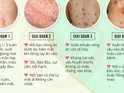 79+ Ảnh bệnh giang mai, nhận biết sớm, điều trị hiệu quả