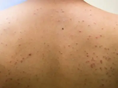 Bạn có đang bị viêm nang lông? 65+ ảnh để biết chính xác