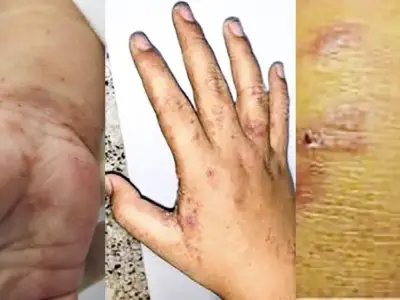 Bệnh ghẻ 95+ hình ảnh thực tế và những điều để phòng tránh