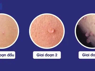 Bệnh mụn cóc là gì? nhận biết qua hình ảnh để điều trị 