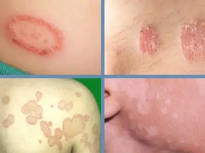 Bệnh nấm da, hình ảnh thực tế và cách nhận biết sớm nhất