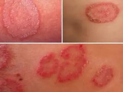 Hình ảnh bệnh Hắc lào, nhận biết sớm để điều trị hiệu quả