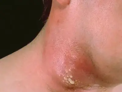 Bộ sưu tập ảnh cận cảnh các loại nhiễm trùng da