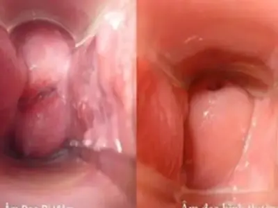 Cảnh báo, nhận biết viêm âm đạo do vi khuẩn qua hình ảnh