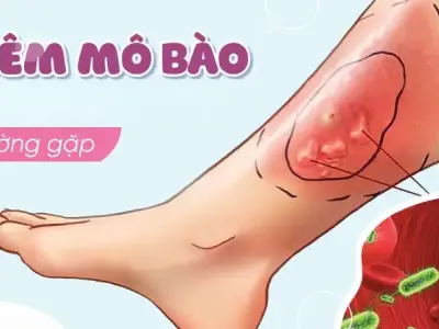 Thư viện hình ảnh Viêm mô tế bào, cập nhật mới nhất