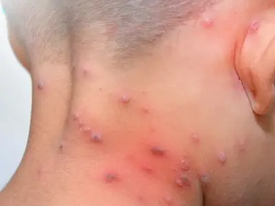 Tổng hợp hình ảnh thủy đậu từ A đến Z về căn bệnh này
