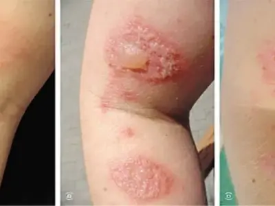 Tổng hợp hình ảnh viêm da tiếp xúc, từ A đến Z