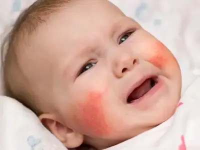 Top 79+ ảnh bệnh Chàm và những điều bạn nên biết về bệnh Chàm