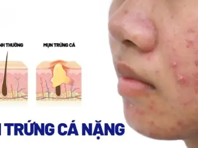 Top 89+ ảnh mụn trứng cá và nguyên nhân gây ra mụn trứng cá 