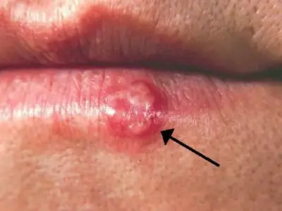 Top 98+ Hình ảnh Herpes, nhận biết sớm để điều trị hiệu quả