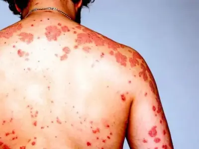 Tư liệu hình ảnh về HIV/AIDS, cảnh báo và phòng ngừa
