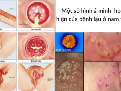 Tuyển tập hình ảnh bệnh lậu ở nam và nữ chi tiết nhất
