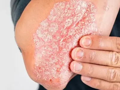 Vảy nến, 79+ hình ảnh thực tế để hiểu rõ hơn về căn bệnh