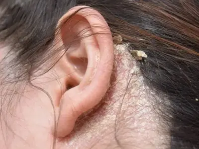 Viêm da tiết bã, hình ảnh minh họa nhận biết điều trị hiệu quả 