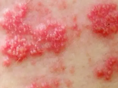 Zona thần kinh, phòng ngừa và điều trị qua hình ảnh