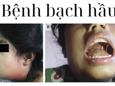 Hình ảnh bệnh bạch hầu và cách phân biệt với viêm amidan