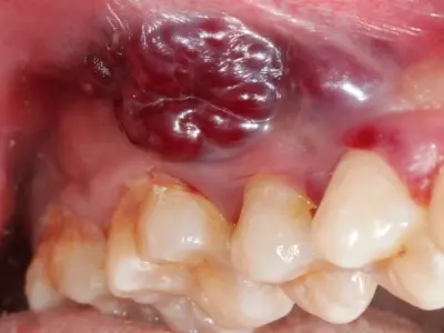 Hình ảnh bệnh bạch sản lưỡi - Dấu hiệu tiền ung thư