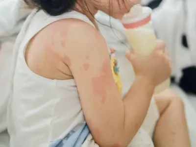 Hình ảnh bệnh chàm đỉa - Các giai đoạn nguy hiểm nhất