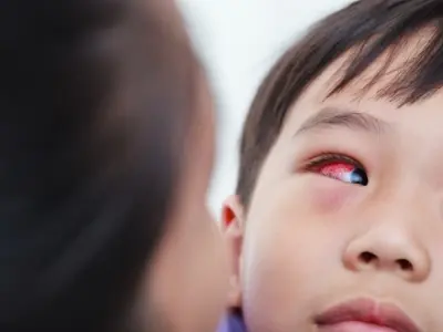 Hình ảnh bệnh đau mắt đỏ - Nhận biết mắt đỏ, ghèn và sưng