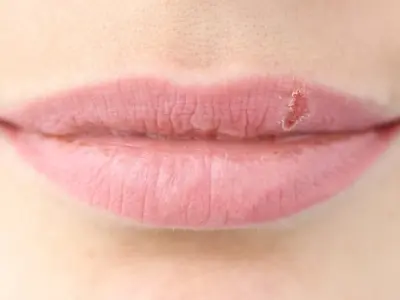 Bộ ảnh thực tế về các triệu chứng của bệnh giời leo ở môi