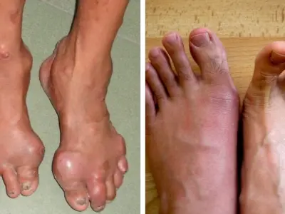 Top những hình ảnh về cơn gout cấp tính và hạt tophi