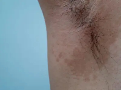 Hình ảnh bệnh hắc lào và dấu hiệu nhận biết điển hình nhất