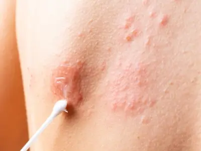 Hình ảnh bệnh herpes và các cụm mụn nước ở môi và sinh dục