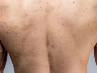 Hình ảnh bệnh lang beng - Nhận biết các đốm trắng trên da