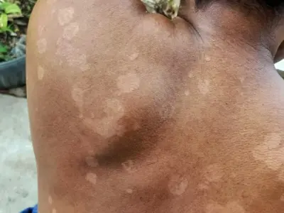 Hình ảnh bệnh lang beng đỏ thực tế - Triệu chứng điển hình
