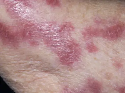 Hình ảnh bệnh lao da và dấu hiệu sớm dễ bị nhầm lẫn