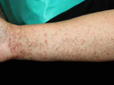 Hình ảnh bệnh lichen - Nhận biết sớm để điều trị hiệu quả