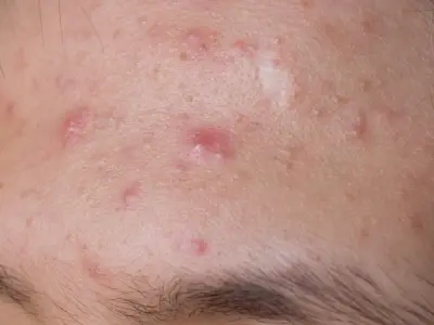 Hình ảnh bệnh mụn trứng cá - Nhận biết các loại mụn thường gặp