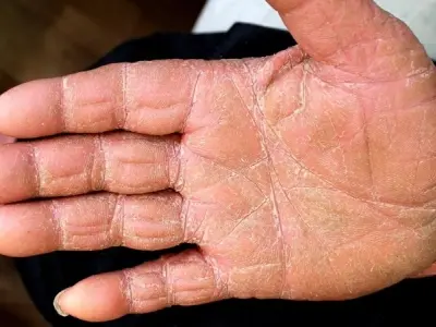 Hình ảnh bệnh nấm da tay - Dấu hiệu và cách điều trị