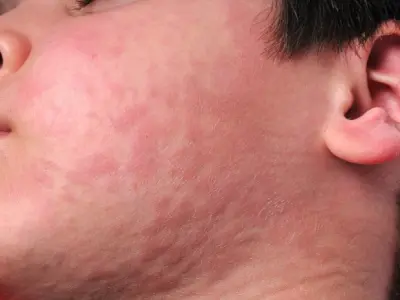 Hình ảnh bệnh phong ngứa - Nguyên nhân và cách điều trị