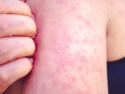 Hình ảnh bệnh rubella và các nốt ban hồng đặc trưng ở trẻ