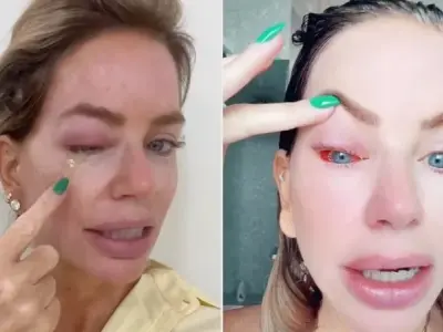 Hình ảnh bệnh sán chó - Nhận biết dấu hiệu nguy hiểm