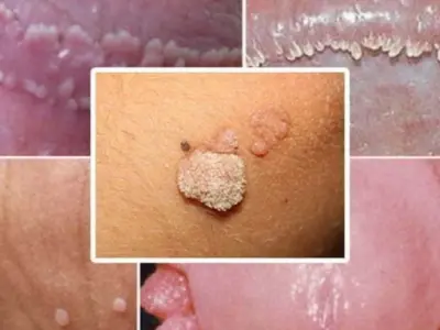 Hình ảnh bệnh sùi mào gà - Dấu hiệu nhận biết sớm