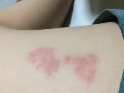 Hình ảnh bệnh thủy đậu ở người lớn qua từng giai đoạn
