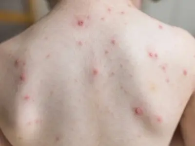 Phân biệt hình ảnh bệnh trái rạ và bệnh tay chân miệng