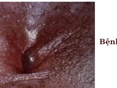 Hình ảnh bệnh trĩ - Nhận biết sớm qua từng giai đoạn