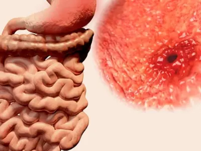 Hình ảnh bệnh viêm loét dạ dày - Các ổ loét qua ảnh nội soi