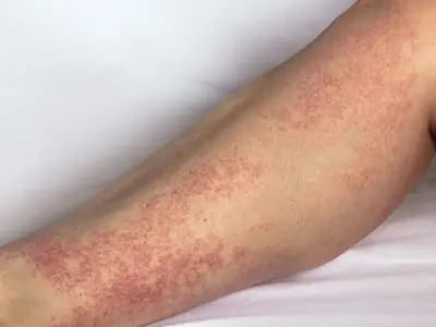 Hình ảnh bệnh viêm mao mạch dị ứng ở trẻ em và người lớn