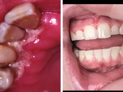 Top những hình ảnh về các cấp độ của bệnh viêm nướu