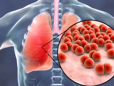Hình ảnh bệnh viêm phổi - Những tổn thương trong phổi