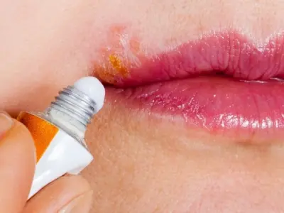 Top những hình ảnh phân biệt zona ở môi và bệnh herpes