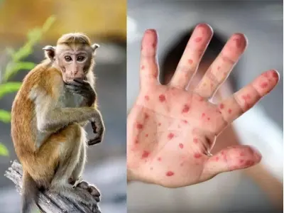 Tuyển tập ảnh đậu mùa khỉ dùng trong giáo dục sức khỏe