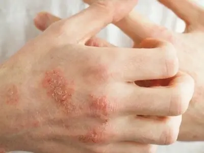 Khám phá ảnh bệnh eczema ấn tượng giúp nhận biết nhanh