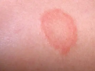 Bệnh lác đồng tiền nguyên nhân, triệu chứng và cách điều trị hiệu quả