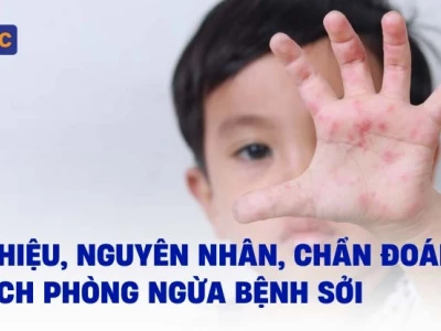 Bệnh sởi là bệnh gì? Nguyên nhân, dấu hiệu và cách phòng ngừa hiệu quả