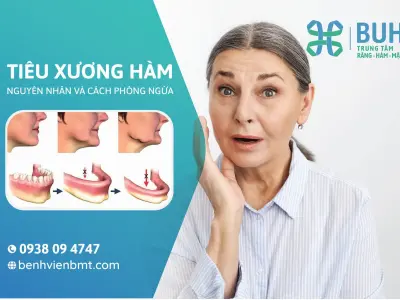 Bệnh Tiêu Xương Là Gì? Nguyên Nhân, Dấu Hiệu Và Cách Điều Trị Hiệu Quả